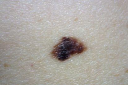 Dysplastic Nevi (Atypical Moles): Treatment | Westerville Dermatology